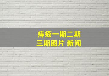 痔疮一期二期三期图片 新闻